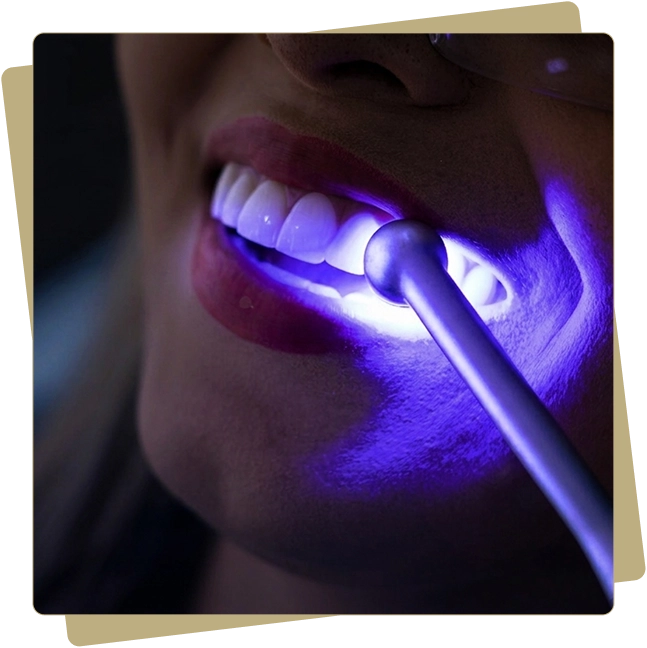 Tooth whitening