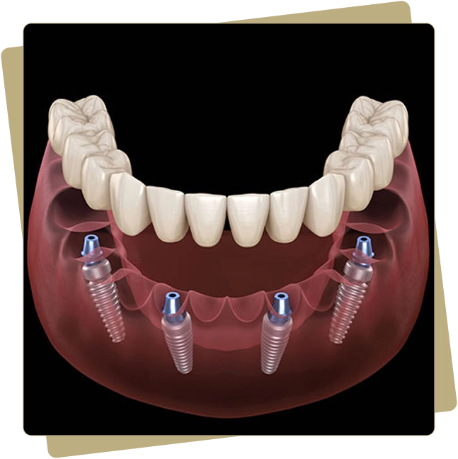 Dental Implants