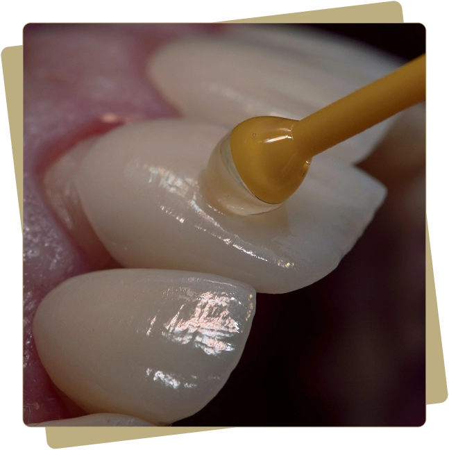 Porcelain veneers
