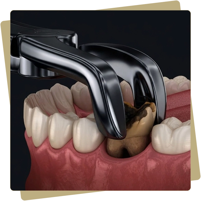 Teeth Extractions