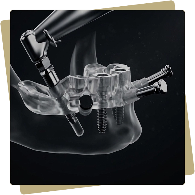 Guided Implant Surgery